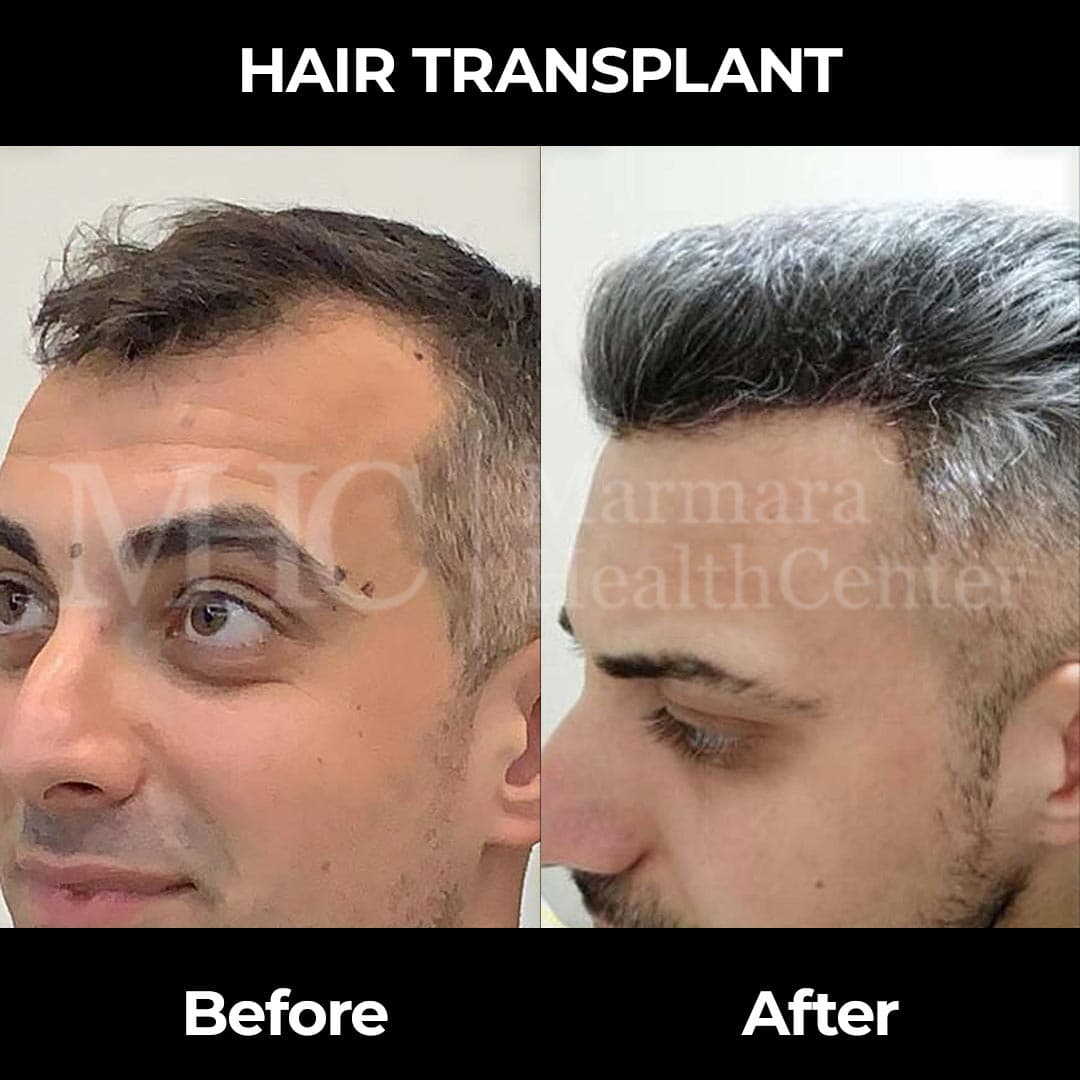 Hair transplant before-after result #6 — Marmara Health Center