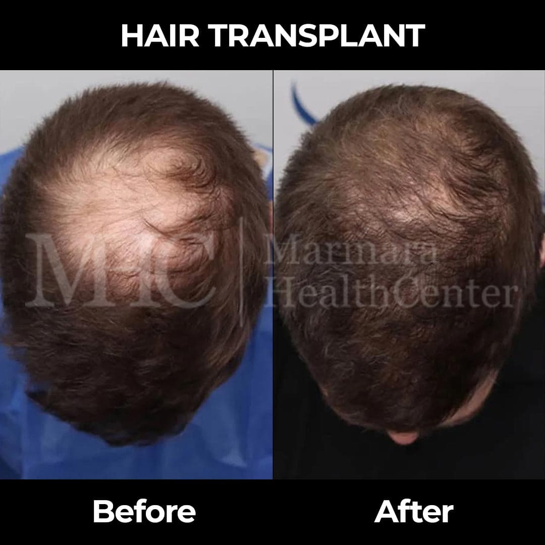 Hair transplant before-after result — DHI method