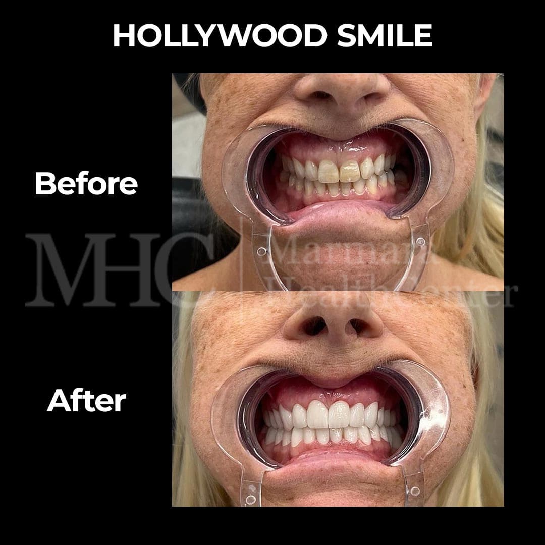 Hollywood smile before-after result — cosmetic dentistry