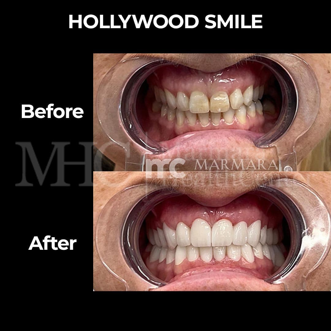 Hollywood smile before-after — laminate veneers