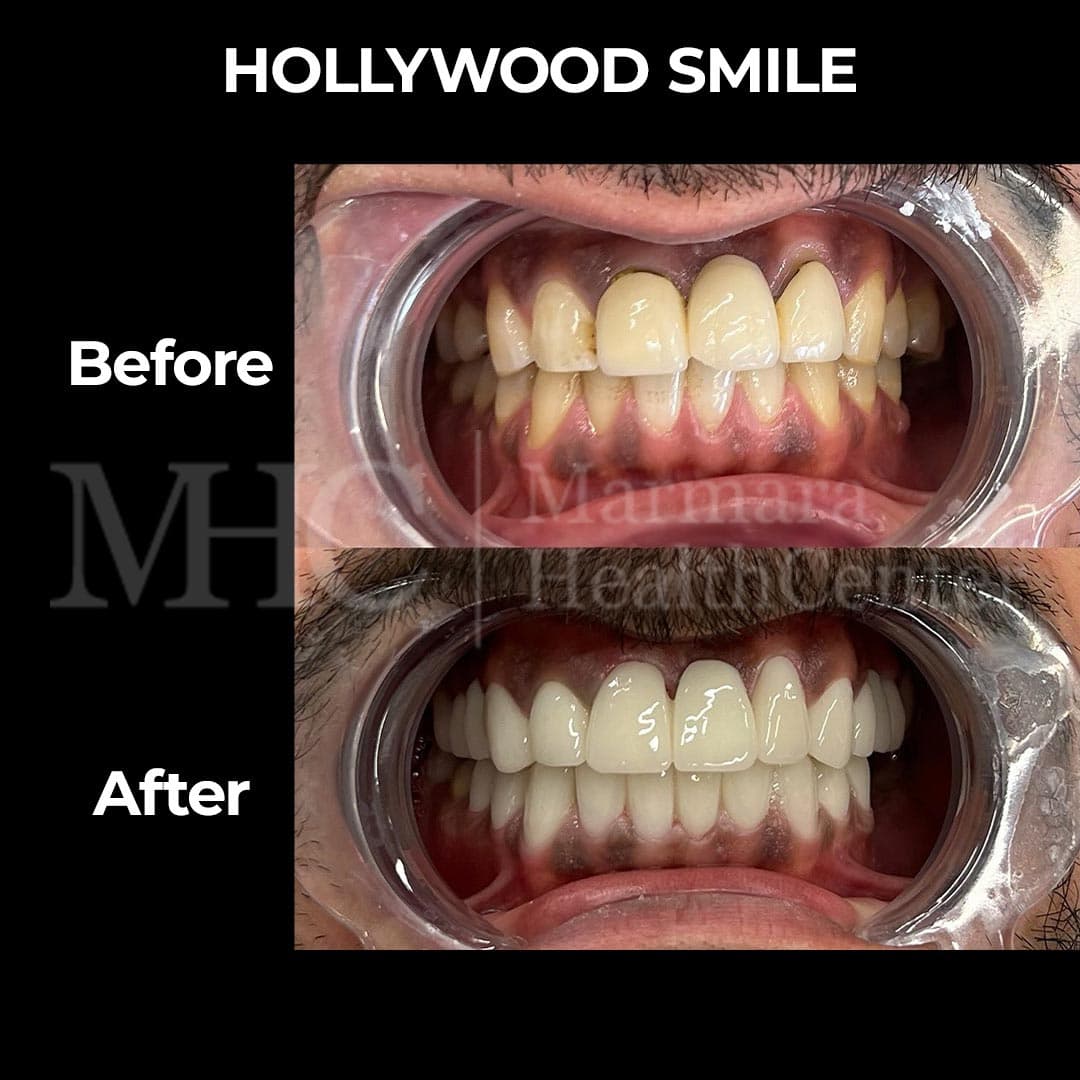 Hollywood smile before-after result #4 — veneer transformation