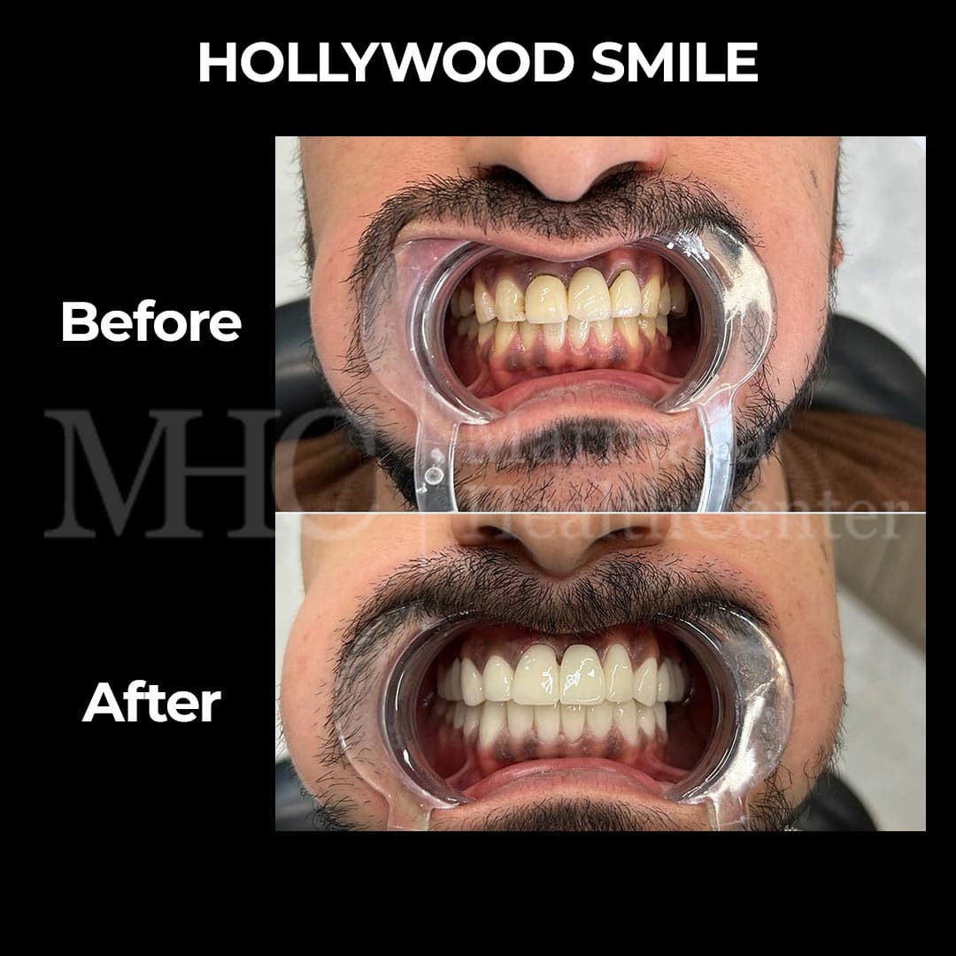 Hollywood smile before-after result #5 — veneer transformation