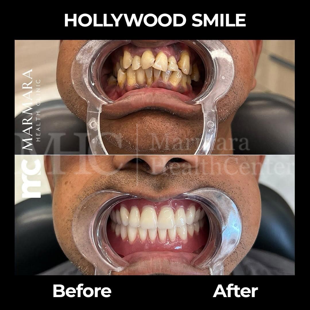 Hollywood smile before-after result — cosmetic dentistry