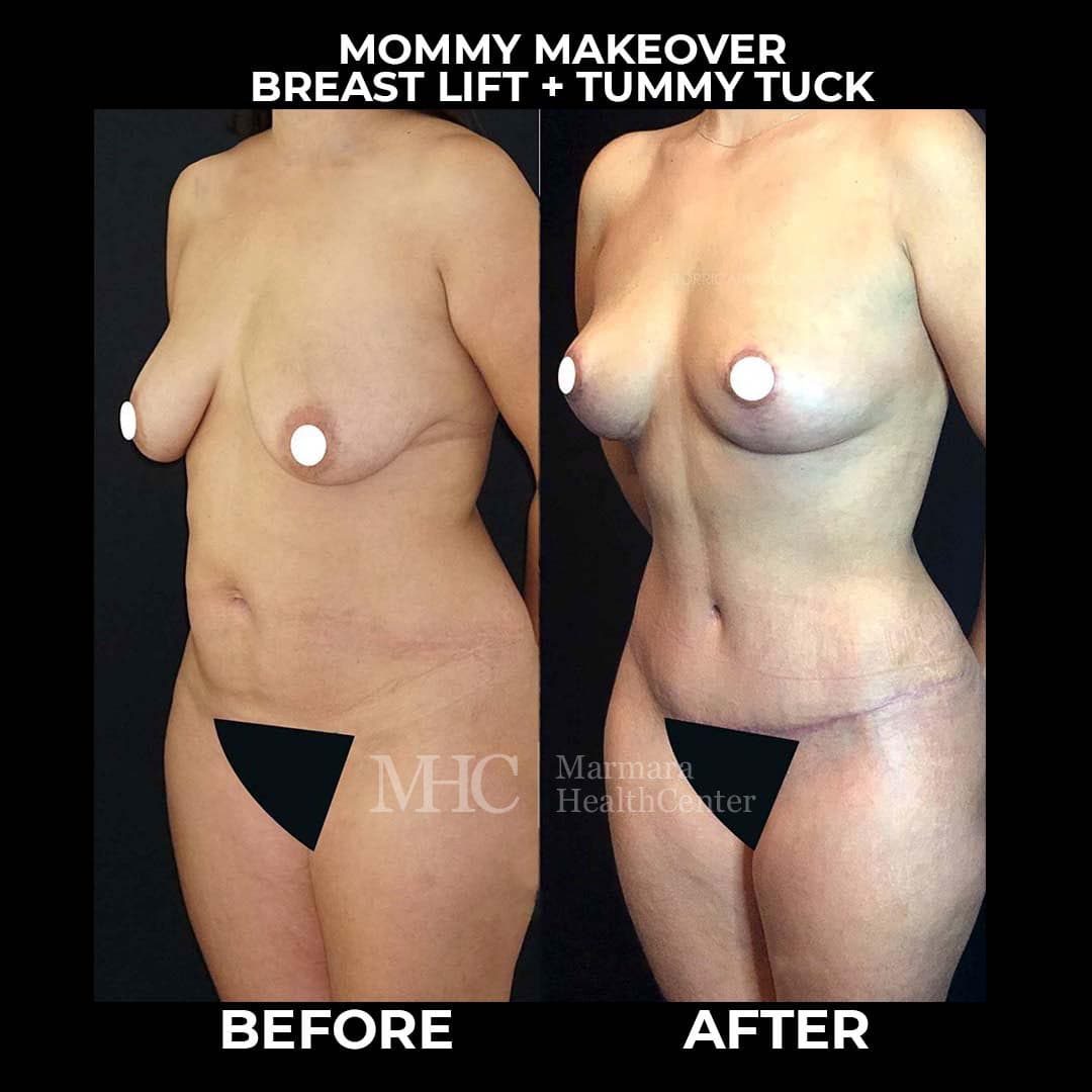 Aesthetic surgery before-after result