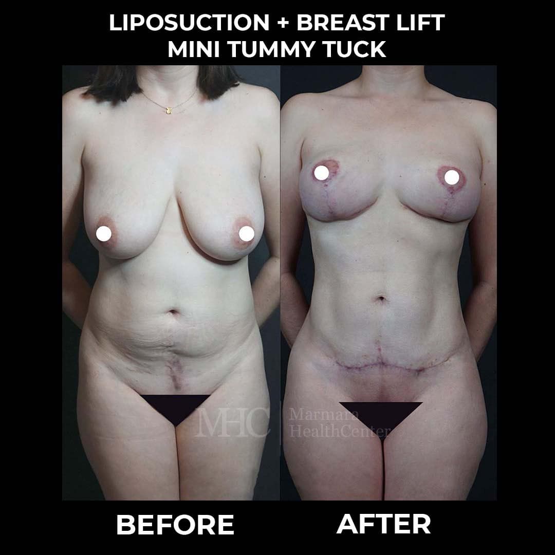 Liposuction before-after result #10 — body contouring at Marmara Health Center