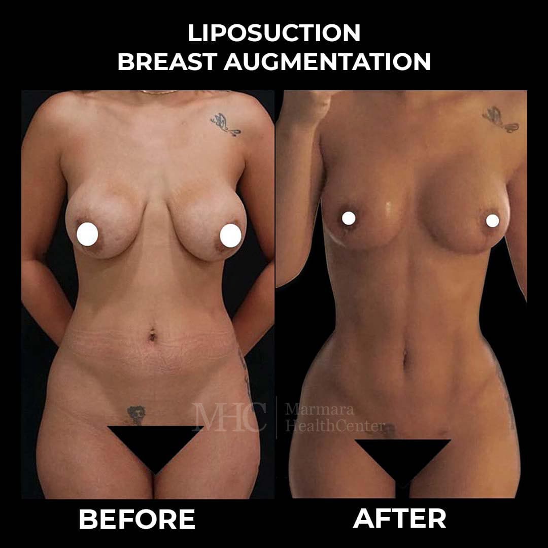 Liposuction before-after result #11 — body contouring at Marmara Health Center