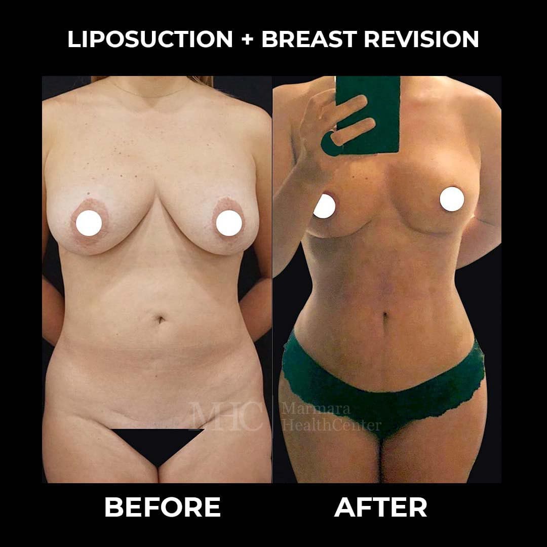 Liposuction before-after result #12 — body contouring at Marmara Health Center