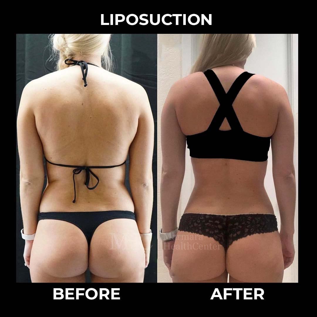 Liposuction before-after result #13 — body contouring at Marmara Health Center