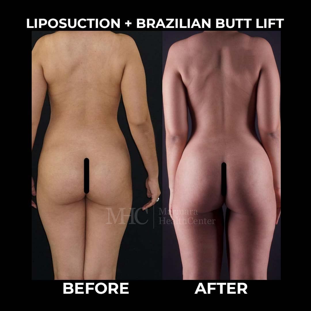 Breast aesthetics before-after result #1 — Marmara Health Center