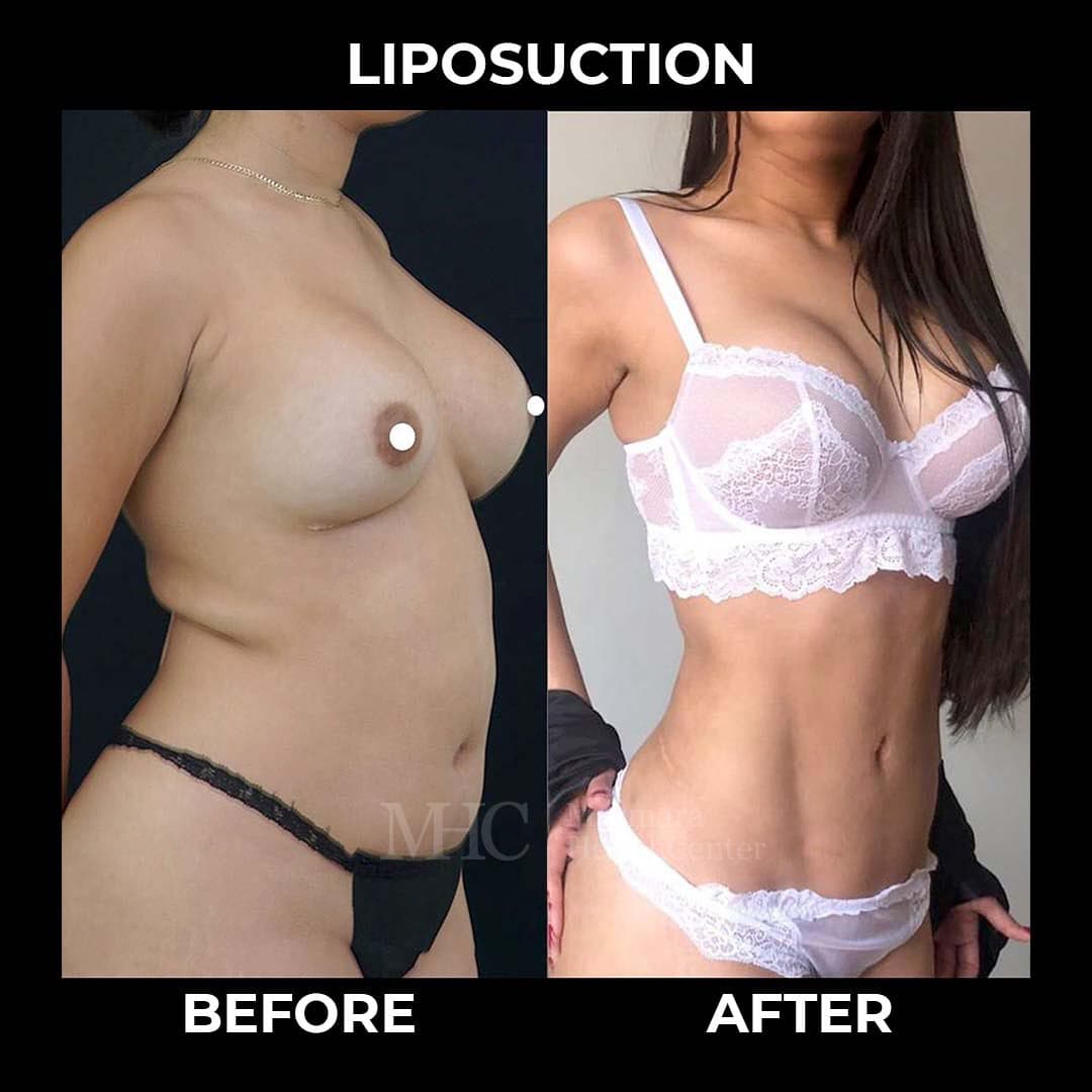 Liposuction before-after result #1 — body contouring at Marmara Health Center