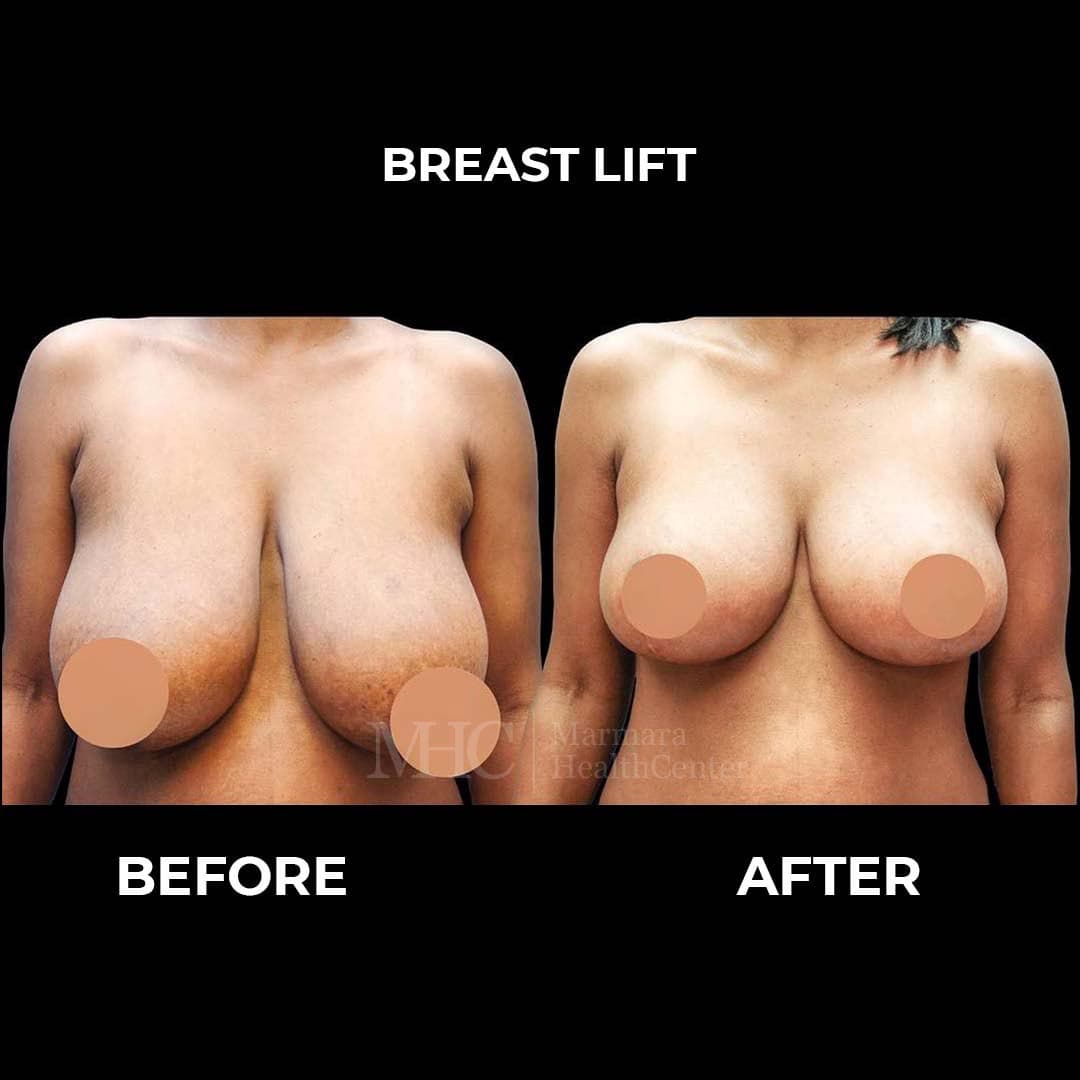 Gynecomastia before-after result #1 — male chest contouring