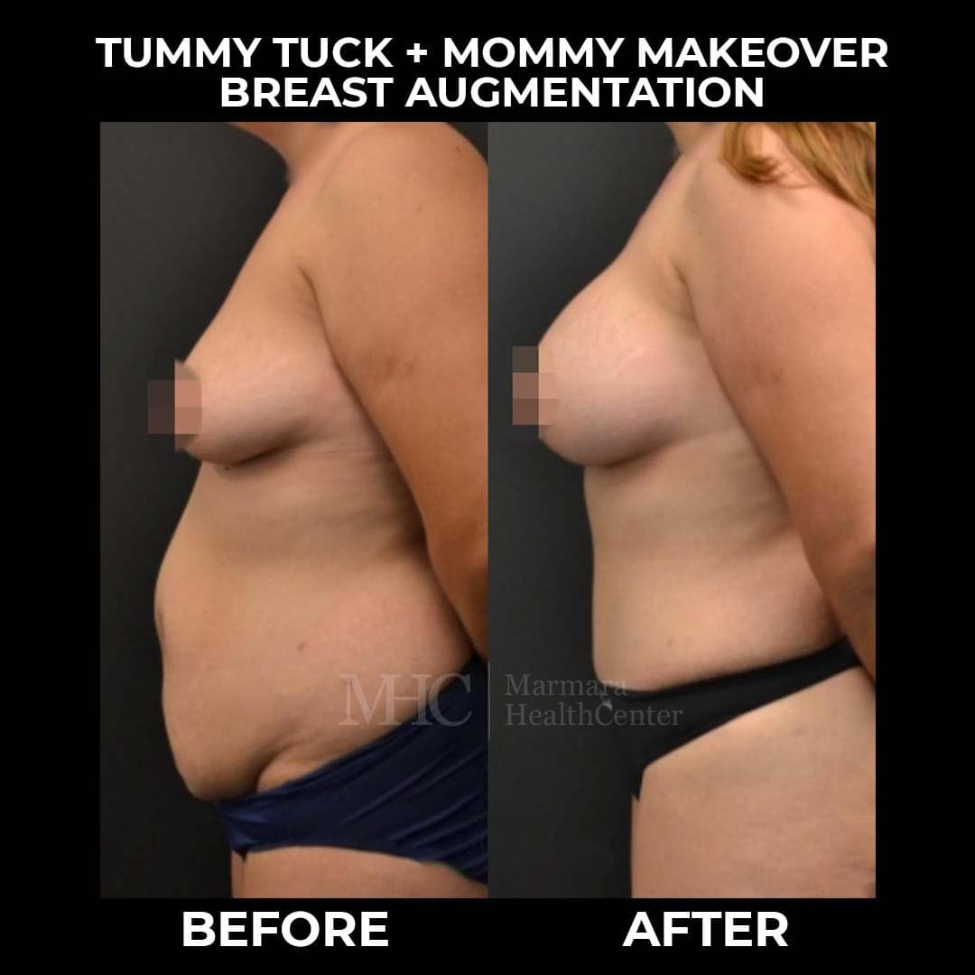 Aesthetic surgery before-after — body contouring