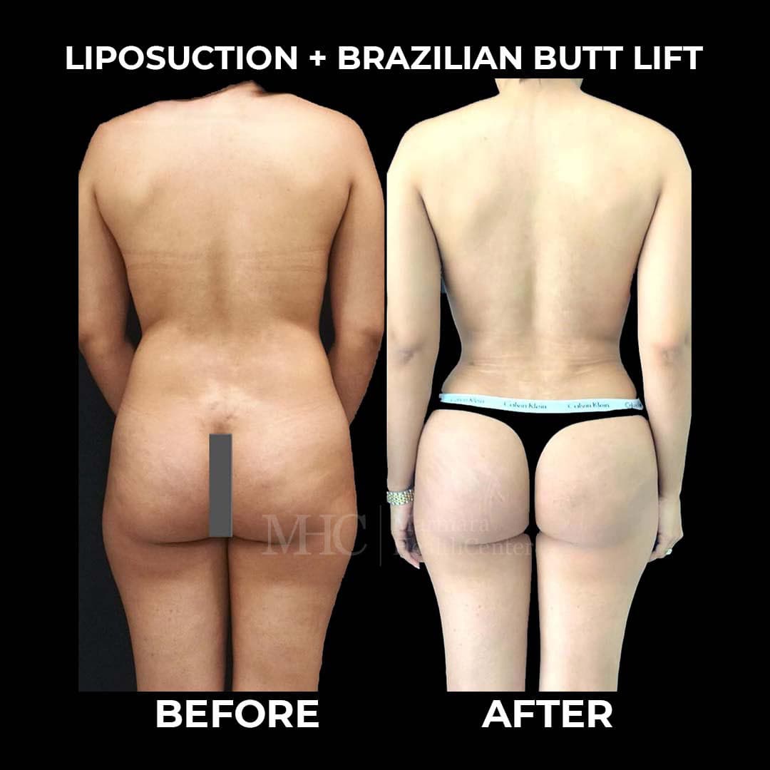 Breast aesthetics before-after result #2 — Marmara Health Center