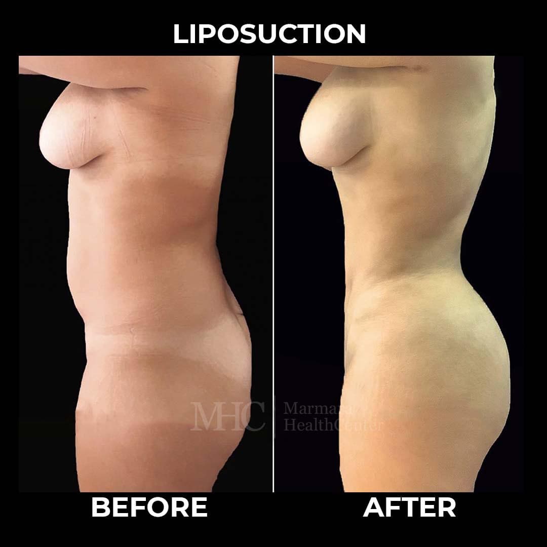 Liposuction before-after result #2 — body contouring at Marmara Health Center