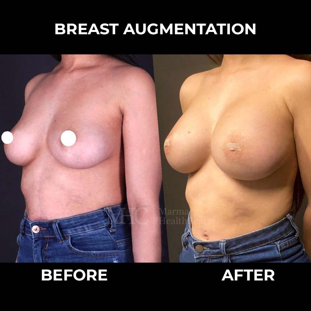 Gynecomastia before-after result #2 — male chest contouring