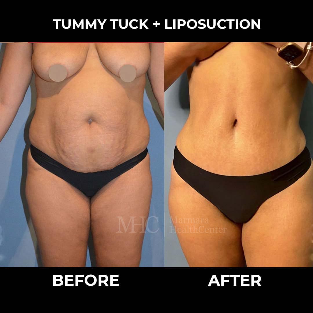 Aesthetic surgery before-after result #3 — body contouring
