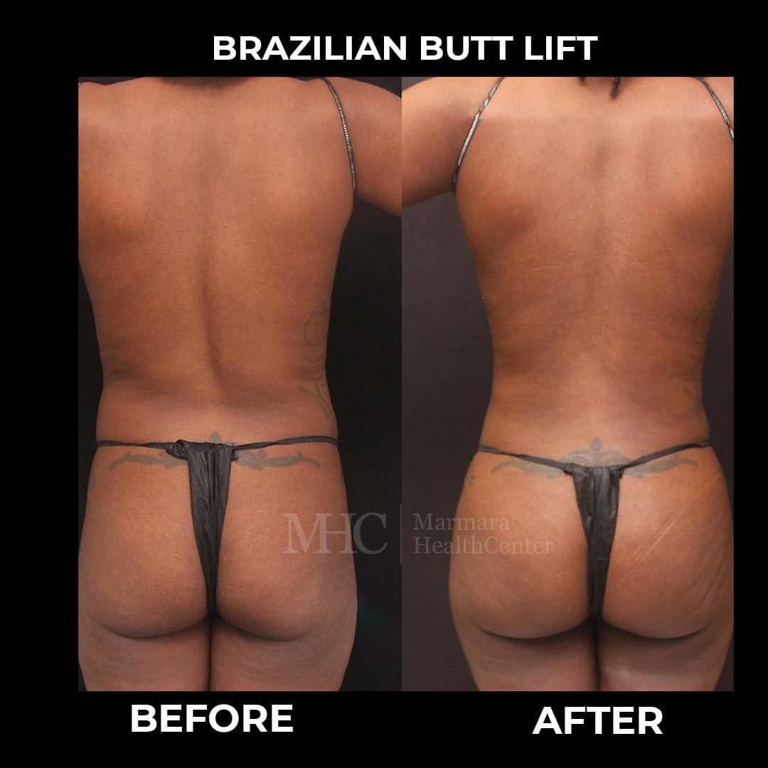 Breast aesthetics before-after result #3 — Marmara Health Center