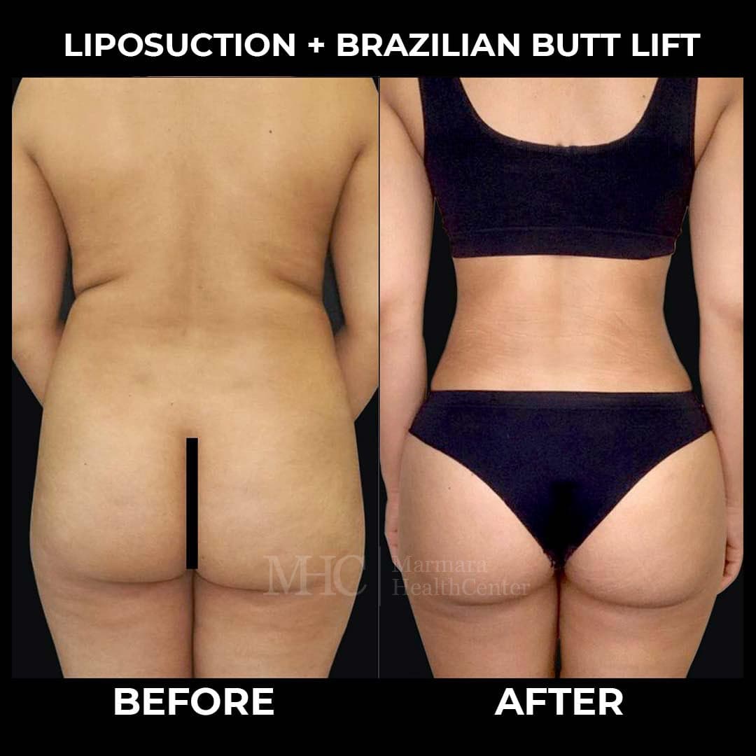 Liposuction before-after result #3 — body contouring at Marmara Health Center