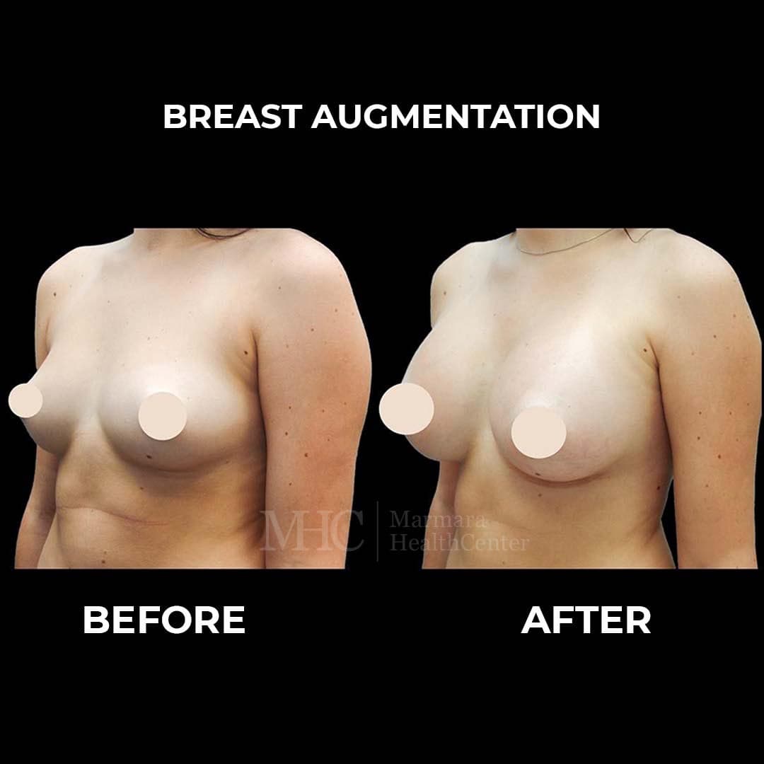 Gynecomastia before-after result #3 — male chest contouring