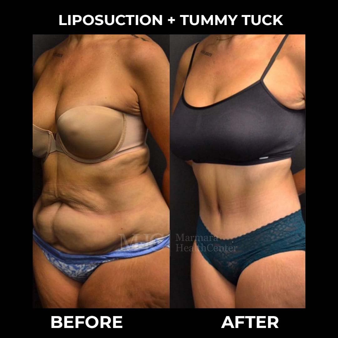Aesthetic surgery before-after result #4 — body contouring