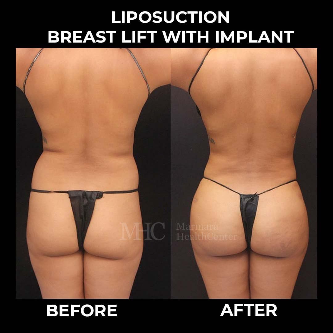 Breast aesthetics before-after result #4 — Marmara Health Center