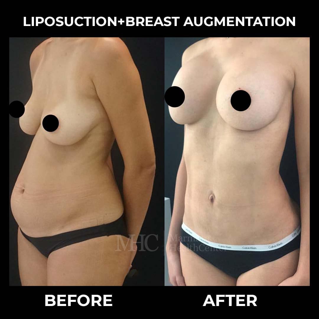 Liposuction before-after result #4 — body contouring at Marmara Health Center