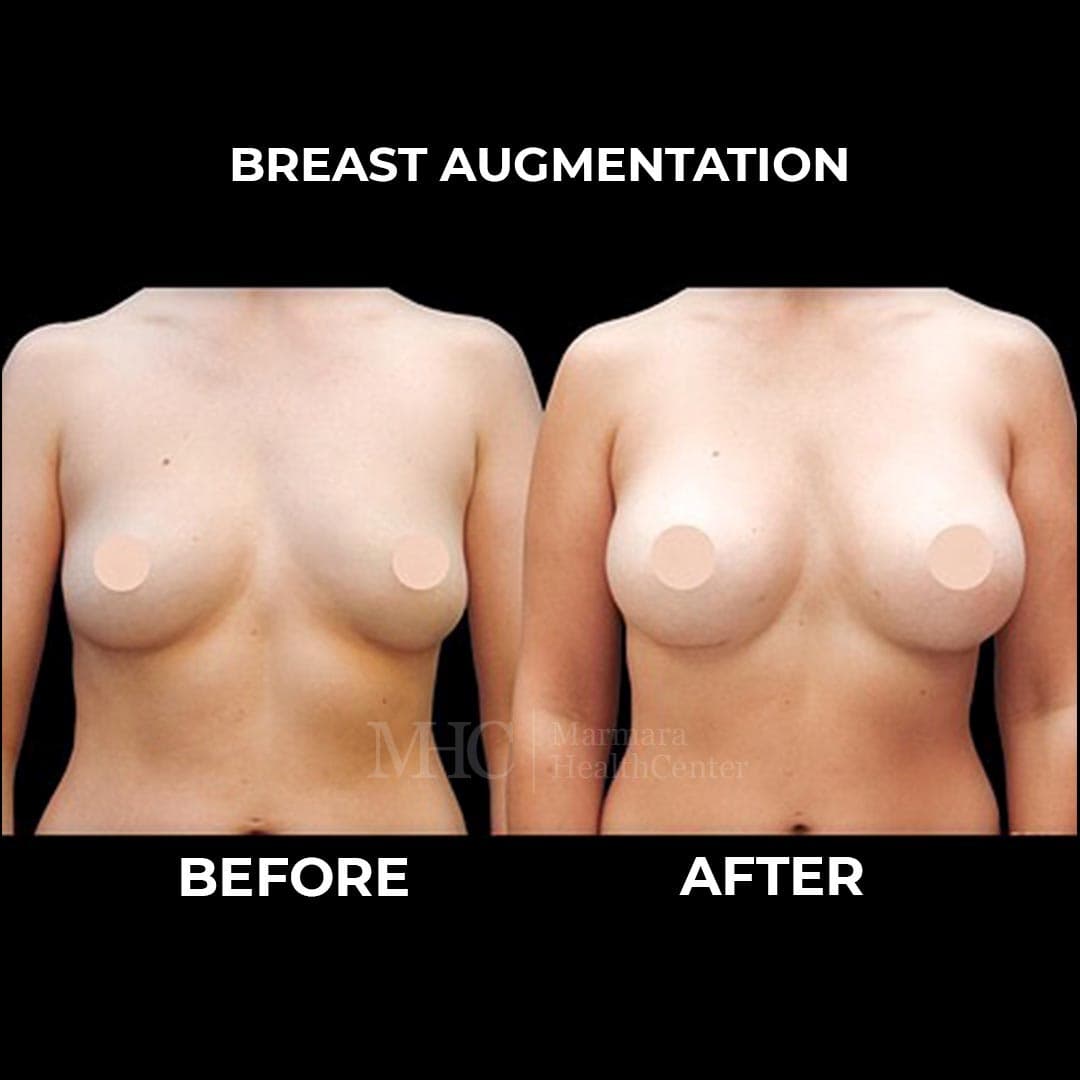 Gynecomastia before-after result #4 — male chest contouring