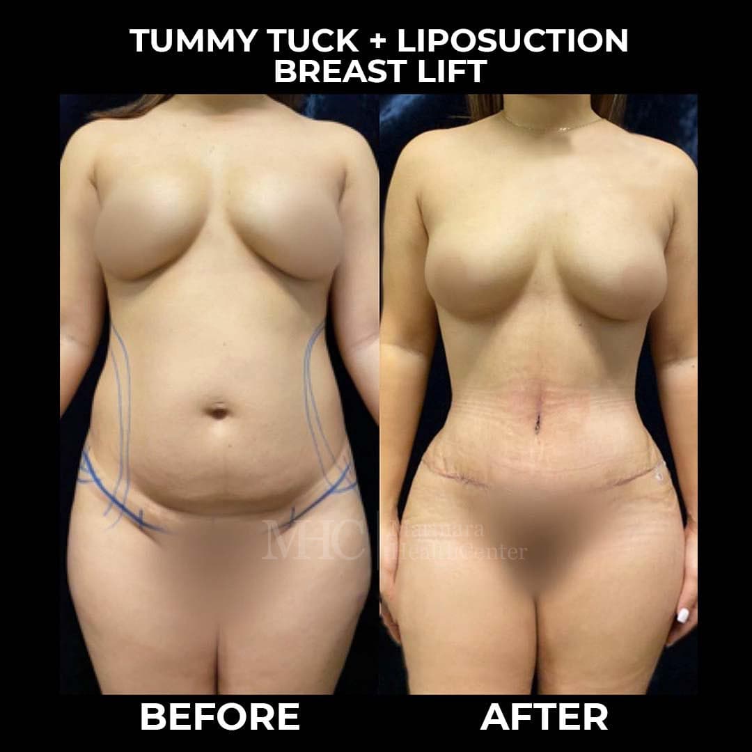 Aesthetic surgery before-after result #5 — body contouring