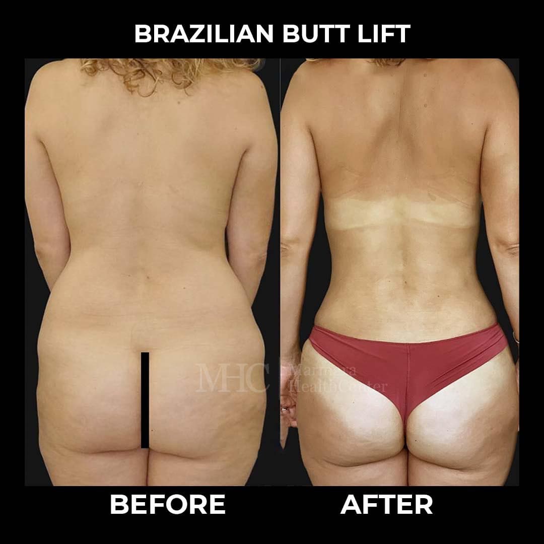 Breast aesthetics before-after result #5 — Marmara Health Center
