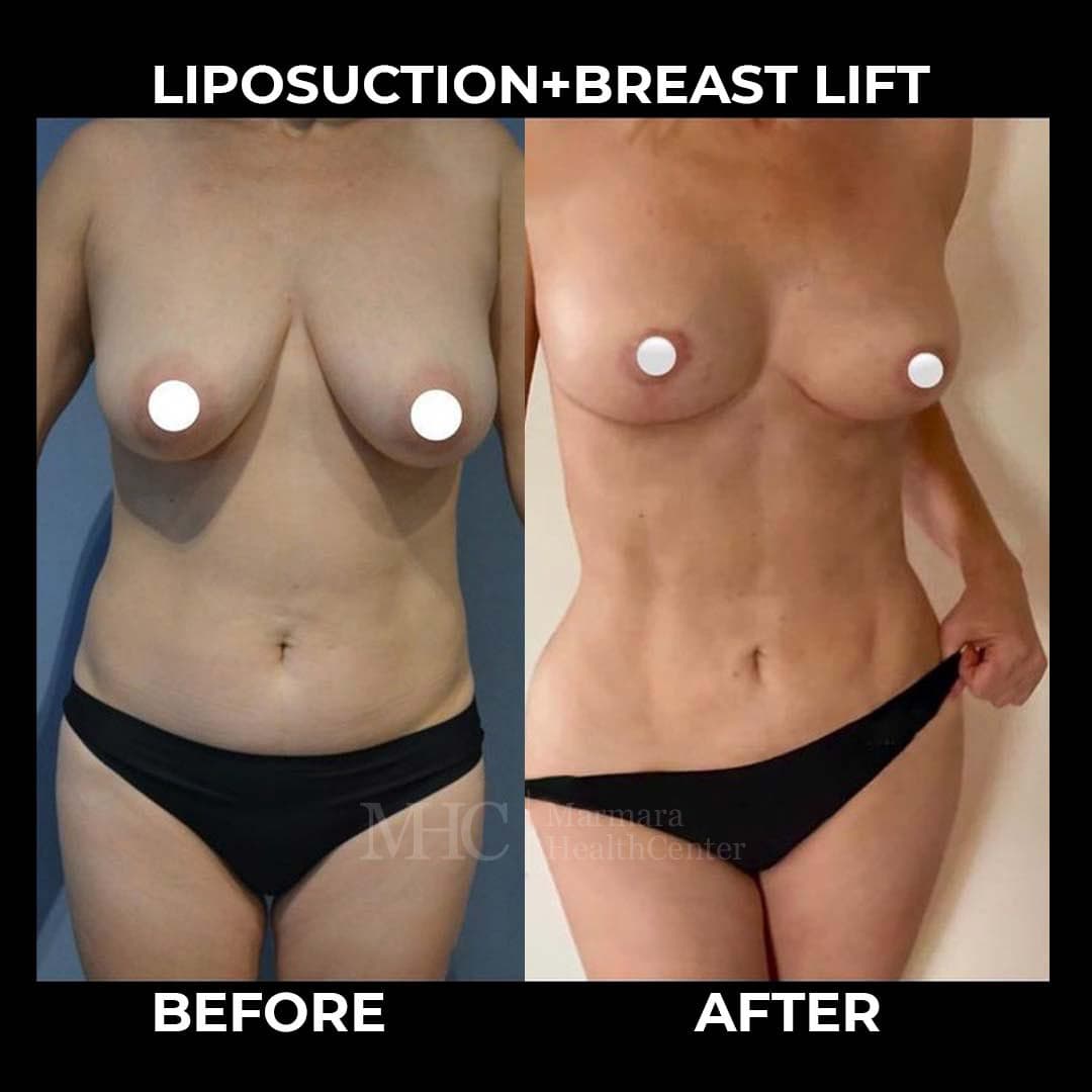 Liposuction before-after result #5 — body contouring at Marmara Health Center