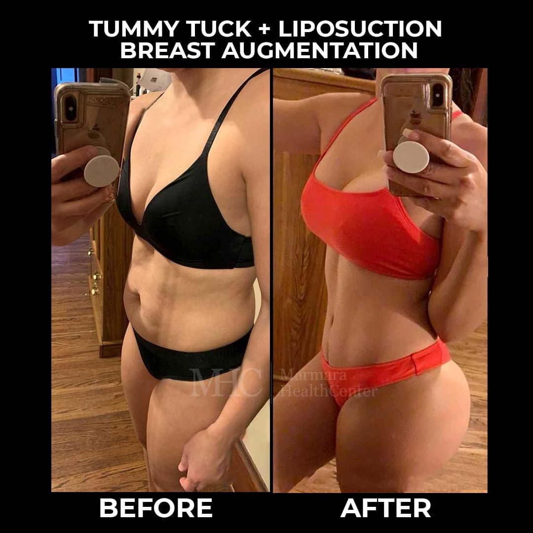Aesthetic surgery before-after result #6 — body contouring