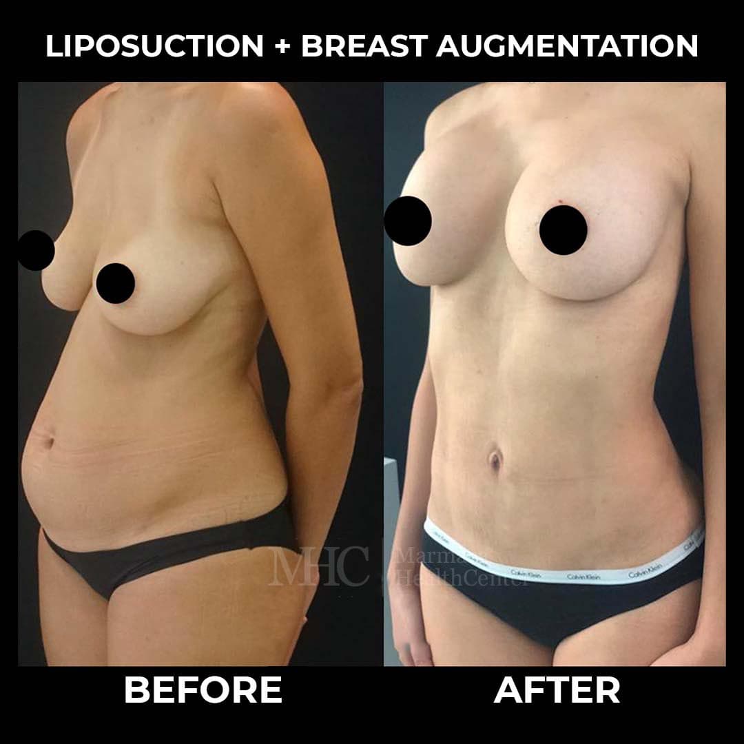 Liposuction before-after result #6 — body contouring at Marmara Health Center