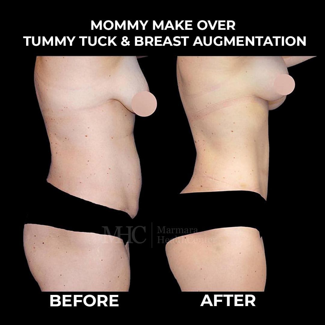 Aesthetic surgery before-after result #7 — body contouring