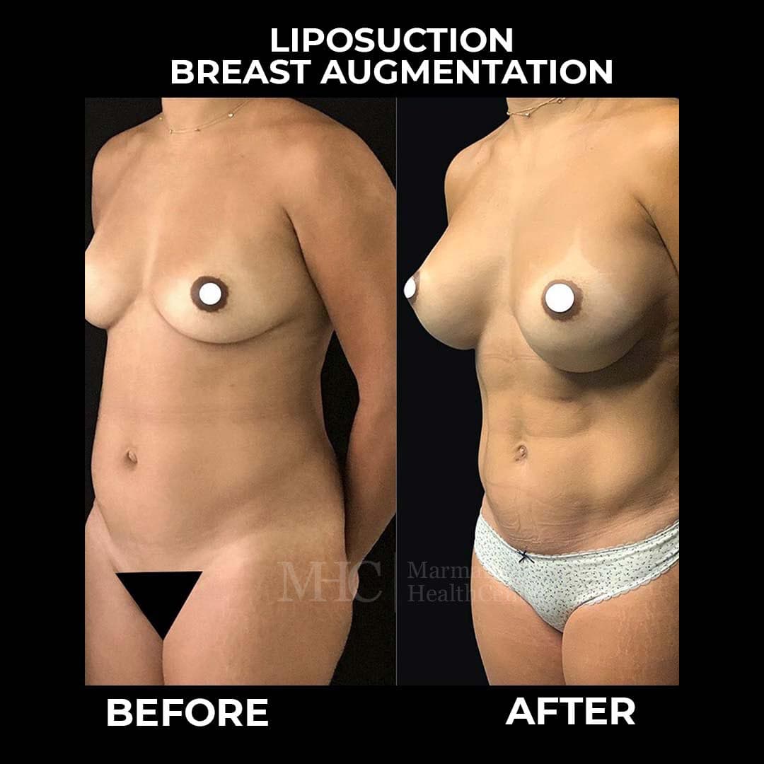 Liposuction before-after result #7 — body contouring at Marmara Health Center