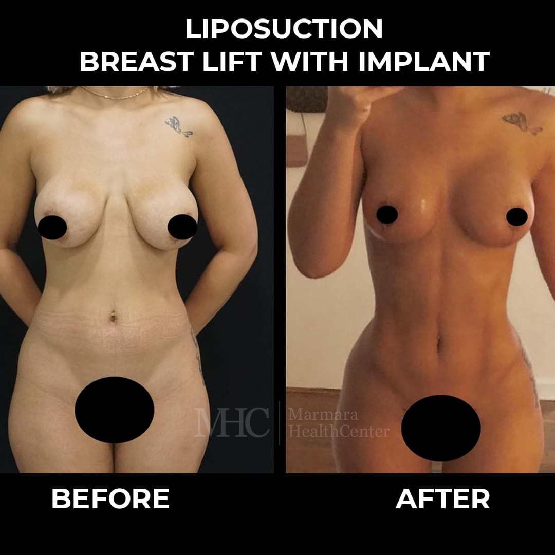 Liposuction before-after result #8 — body contouring at Marmara Health Center