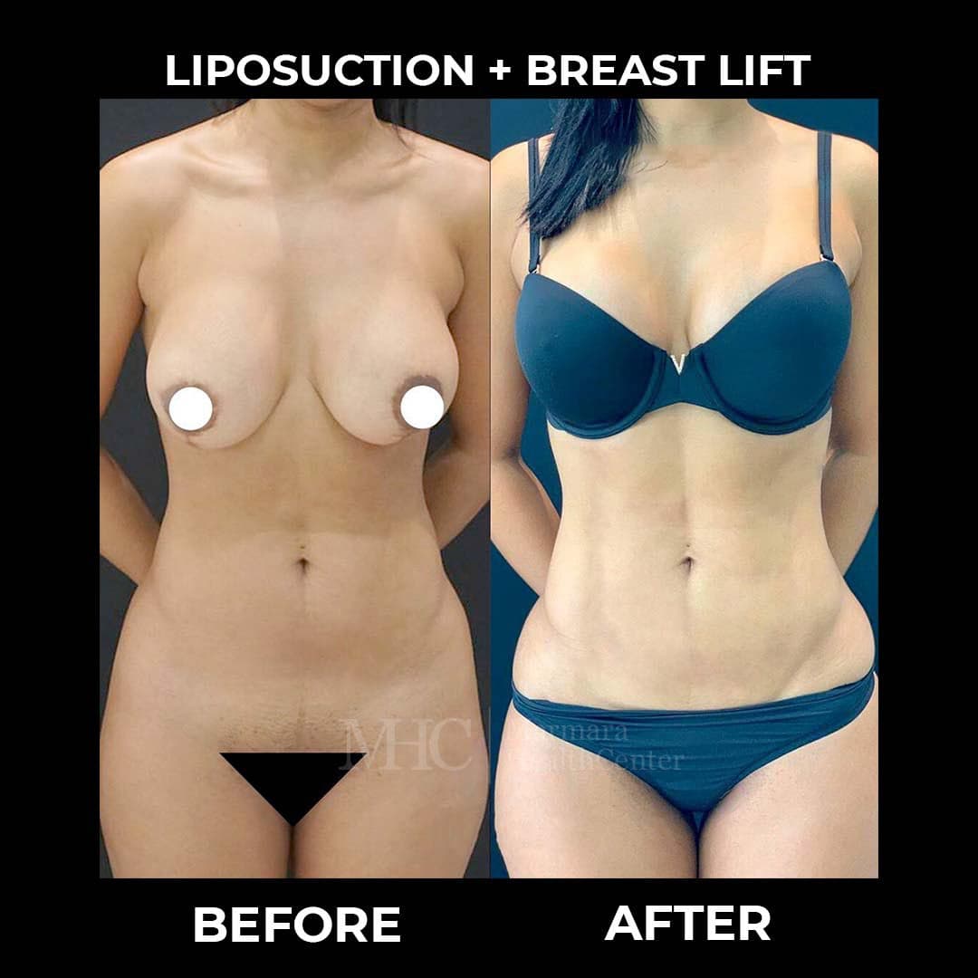 Liposuction before-after result #9 — body contouring at Marmara Health Center
