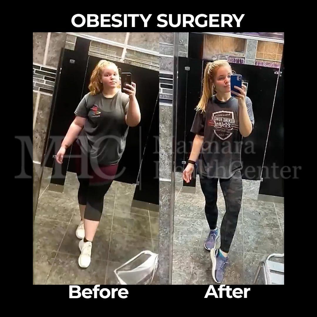 Obesity surgery before-after result — weight loss outcome