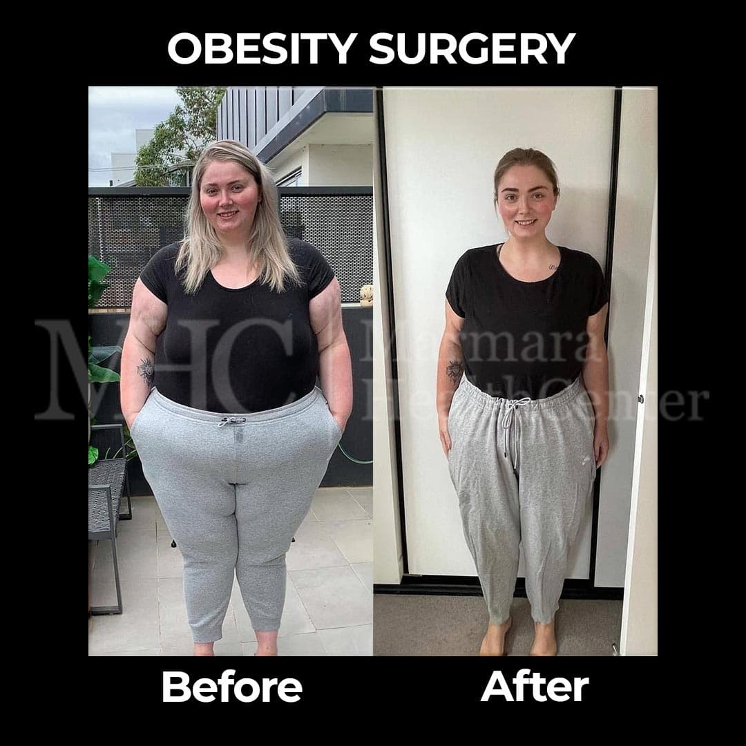 Obesity surgery before-after result — weight loss transformation