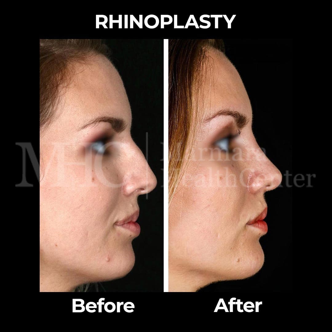Rhinoplasty before-after result #10 — Marmara Health Center