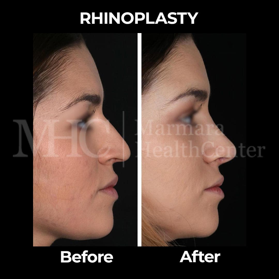 Rhinoplasty before-after result #11 — Marmara Health Center
