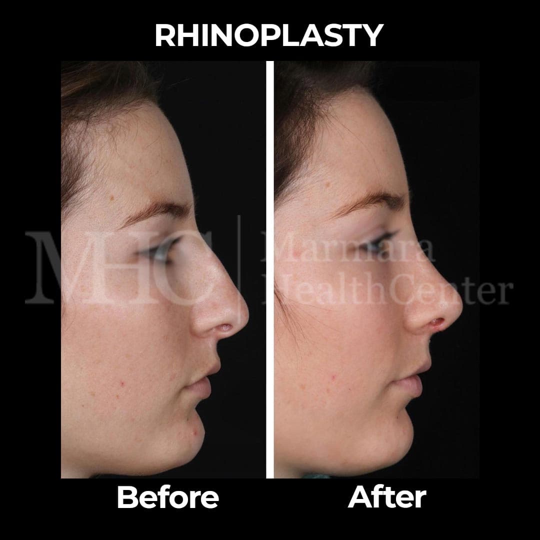 Rhinoplasty before-after result #12 — Marmara Health Center