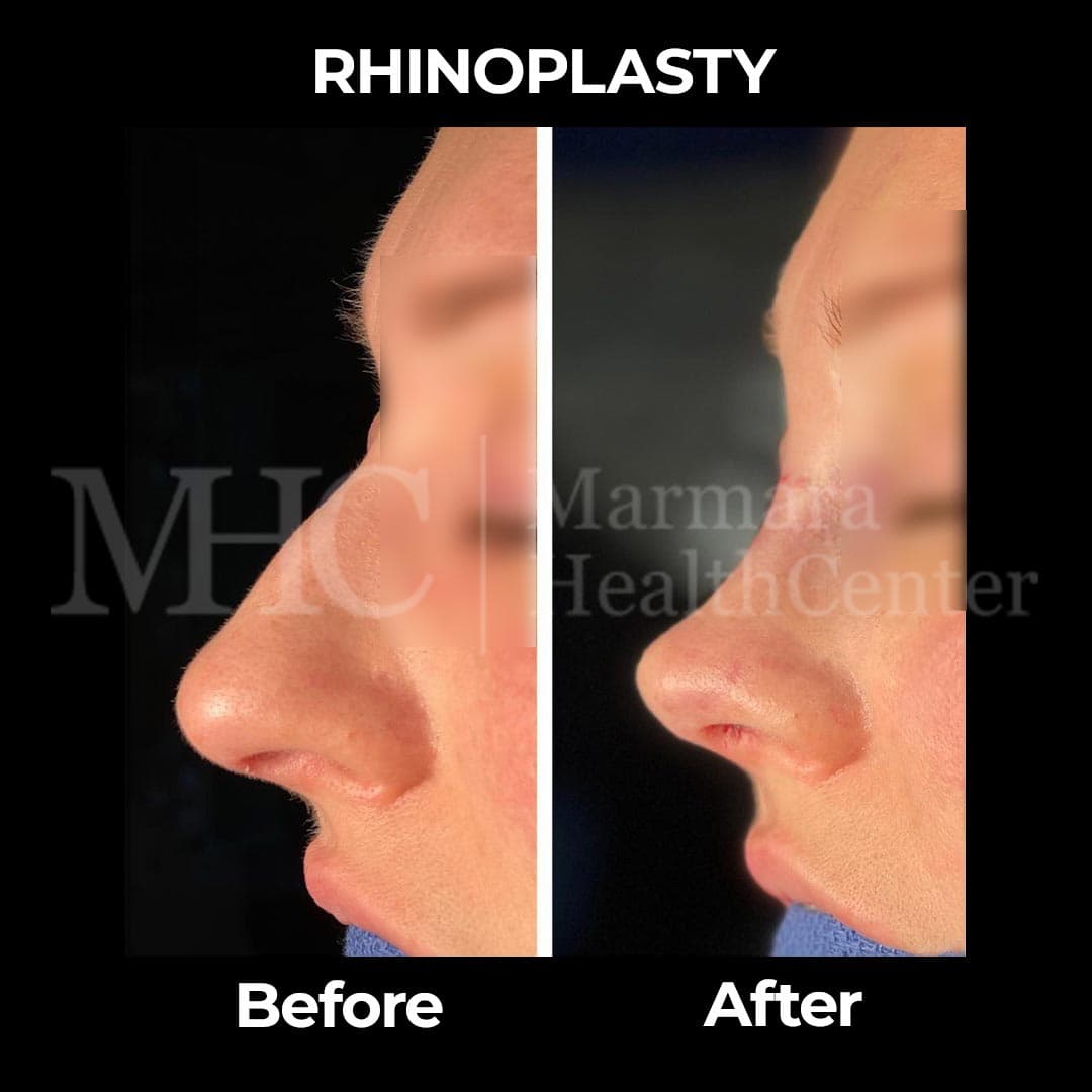 Rhinoplasty before-after result #13 — Marmara Health Center