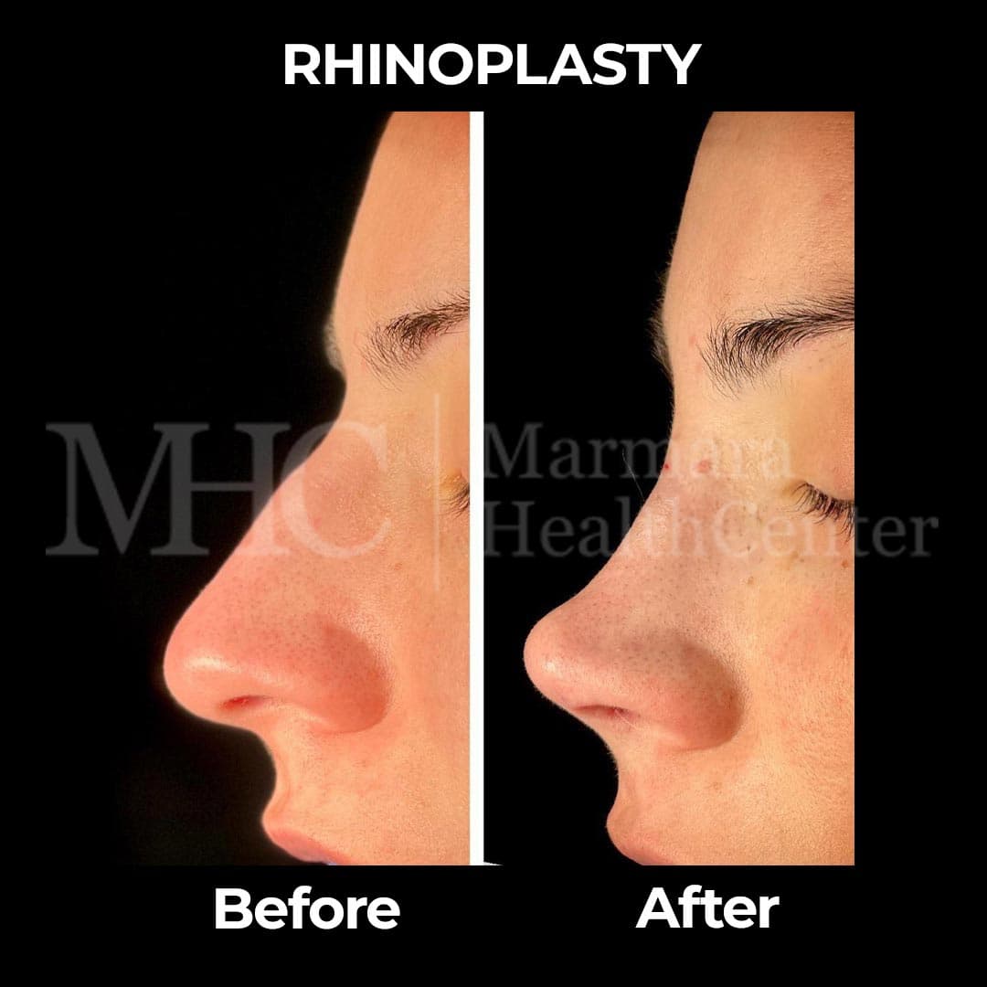 Rhinoplasty before-after result #14 — Marmara Health Center