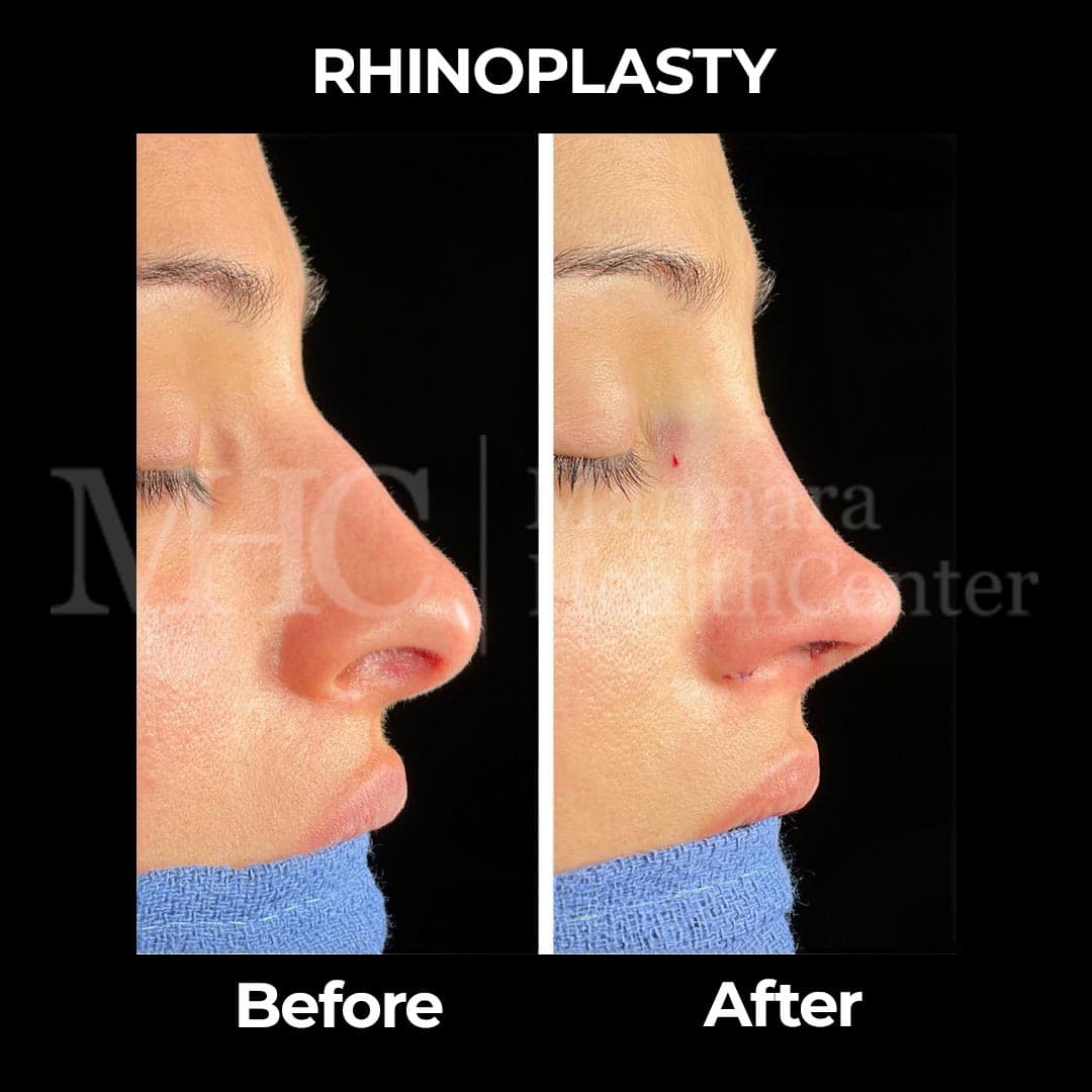 Rhinoplasty before-after result #16 — Marmara Health Center