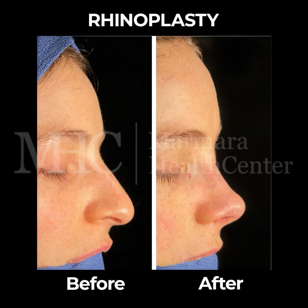 Rhinoplasty before-after result #17 — Marmara Health Center