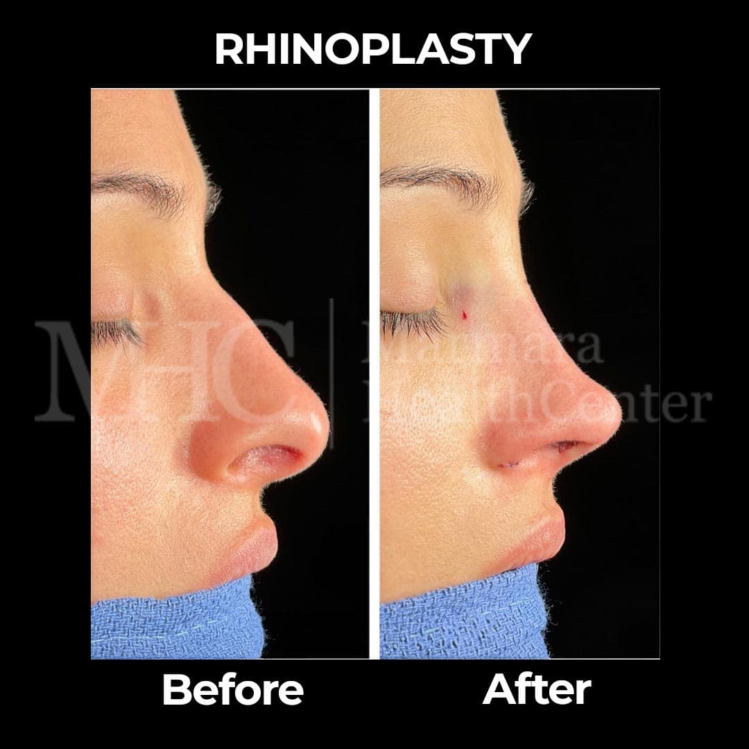 Rhinoplasty before-after result #18 — Marmara Health Center