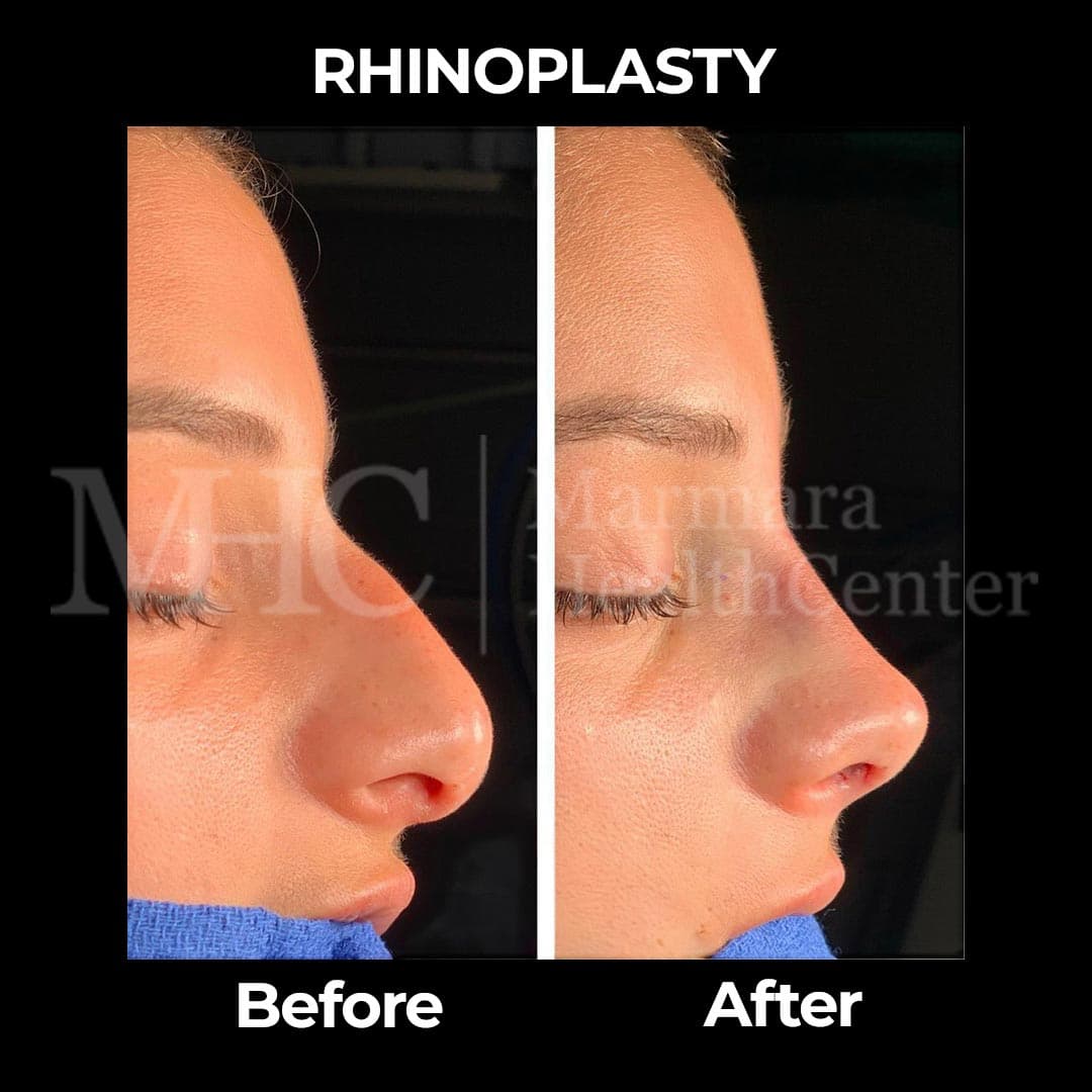 Rhinoplasty before-after result #19 — Marmara Health Center