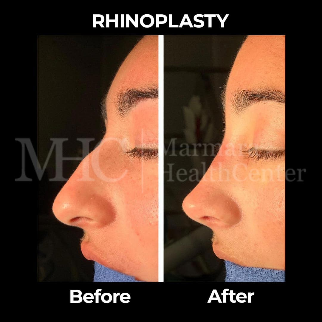 Rhinoplasty before-after result #20 — Marmara Health Center