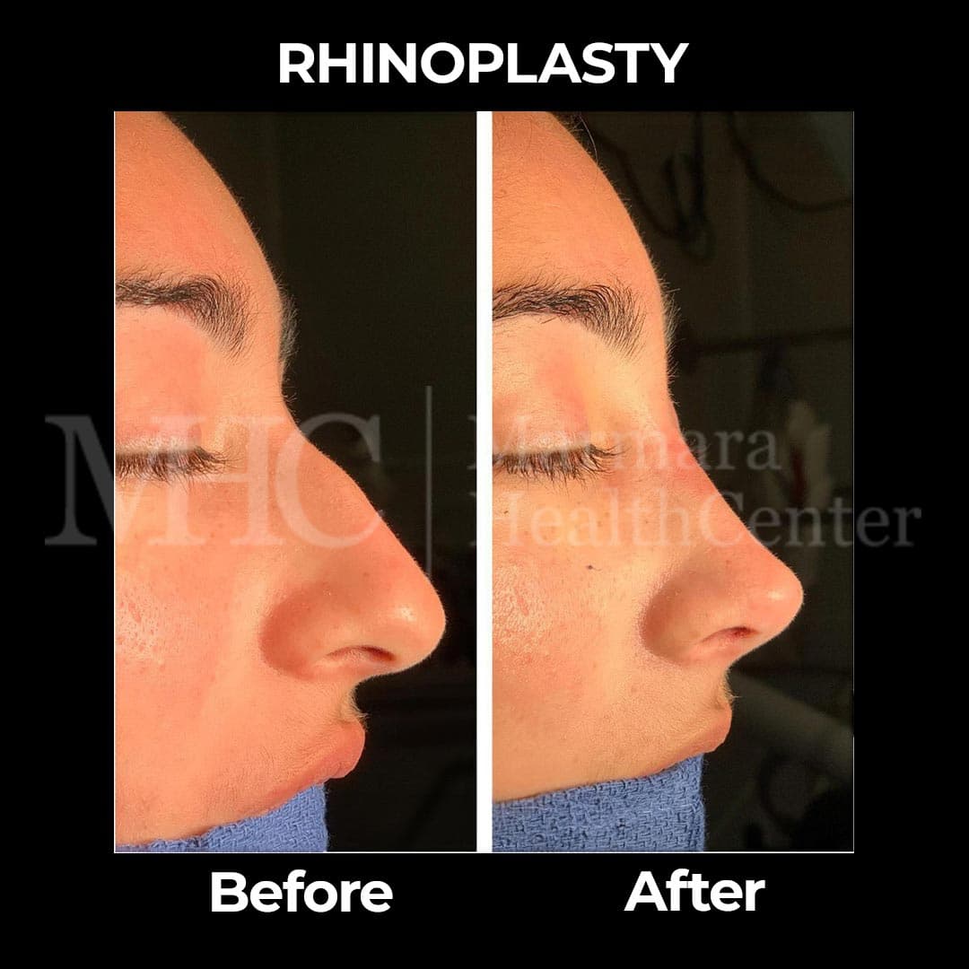 Rhinoplasty before-after result #21 — Marmara Health Center