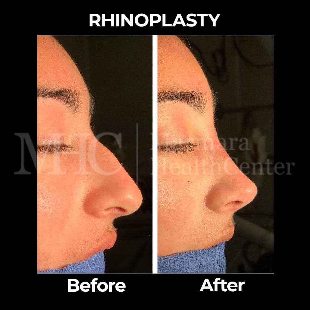 Rhinoplasty before-after result #22 — Marmara Health Center